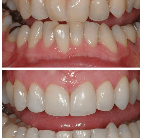 dental bonding crooked teeth