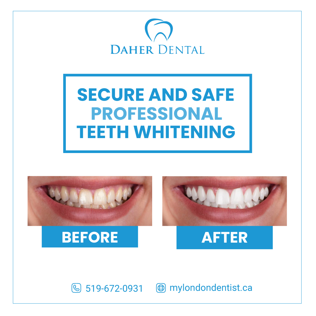 Teeth Whitening In London Ontario