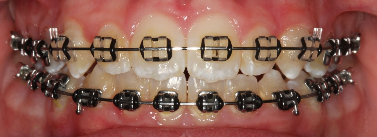 What Are Power Chains For Braces?