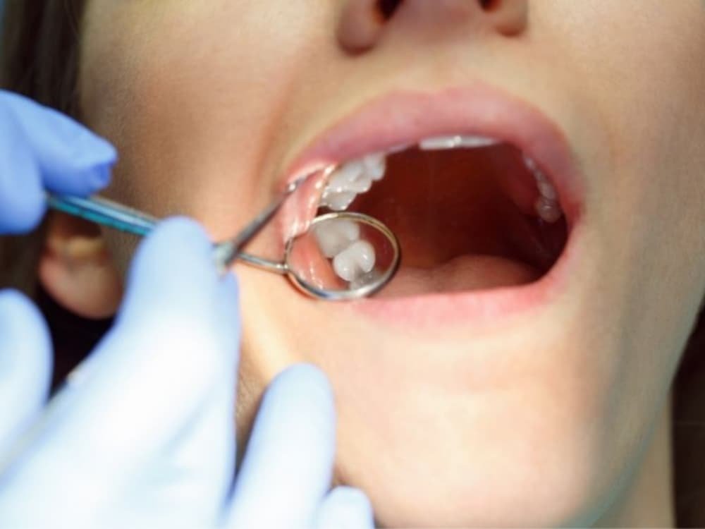 Aftercare for Tooth Extraction