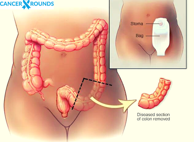 colon cancer