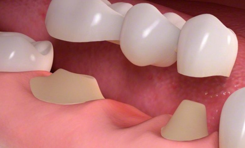 removable dental bridges