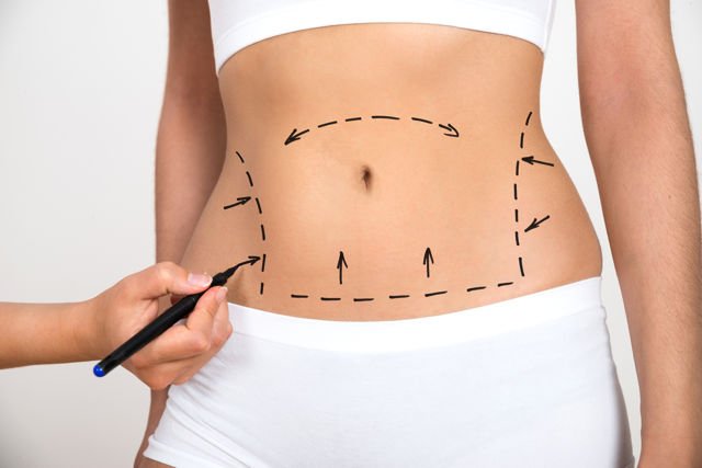 5 Cosmetic Procedures to Help You Achieve Your Desired Body