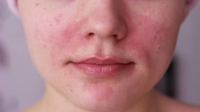 how to Treat Rosacea